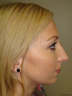 Rhinoplasty Before and After 17 | Sanjay Grover MD FACS