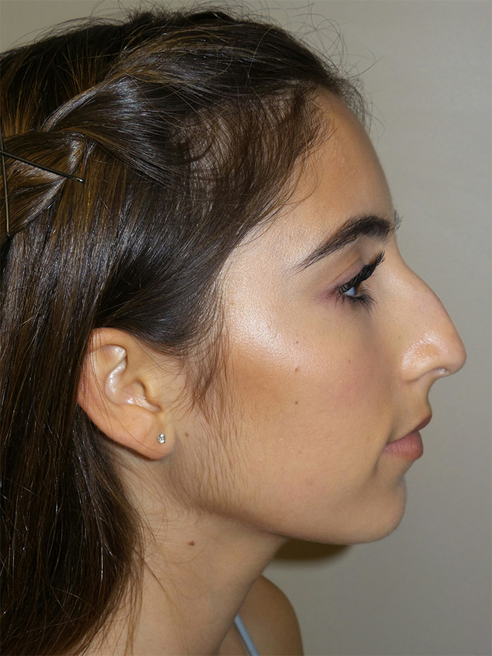 Rhinoplasty Before and After 26 | Sanjay Grover MD FACS
