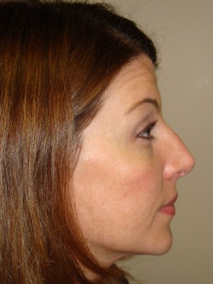 Rhinoplasty Before and After 32 | Sanjay Grover MD FACS