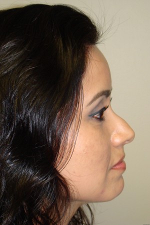 Rhinoplasty Before and After 40 | Sanjay Grover MD FACS