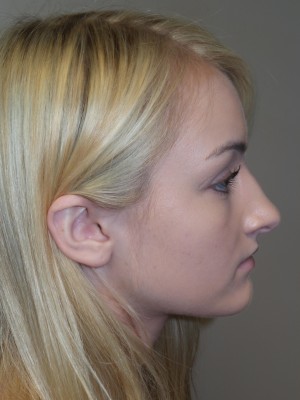 Rhinoplasty Before and After 29 | Sanjay Grover MD FACS