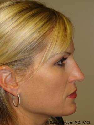 Rhinoplasty Before and After 19 | Sanjay Grover MD FACS