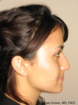 Rhinoplasty Before and After 39 | Sanjay Grover MD FACS