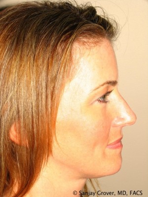 Rhinoplasty Before and After | Sanjay Grover MD FACS