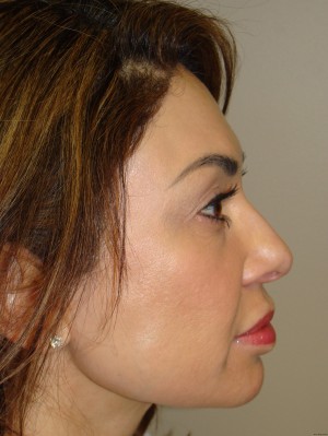 Rhinoplasty Before and After 06 | Sanjay Grover MD FACS