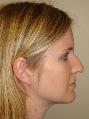 Rhinoplasty Before and After 15 | Sanjay Grover MD FACS