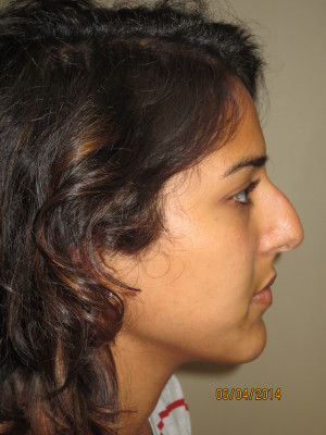 Rhinoplasty Before and After 35 | Sanjay Grover MD FACS