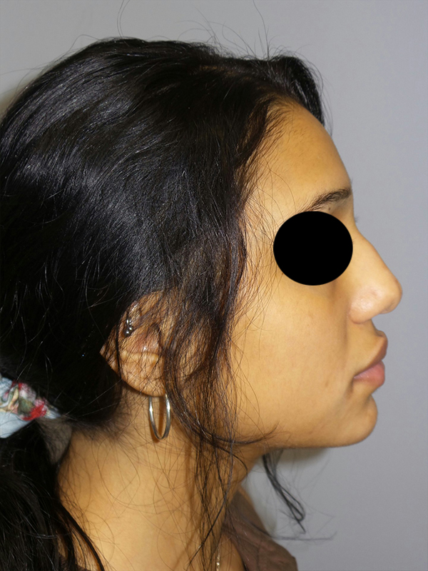 Rhinoplasty Before and After 35 | Sanjay Grover MD FACS