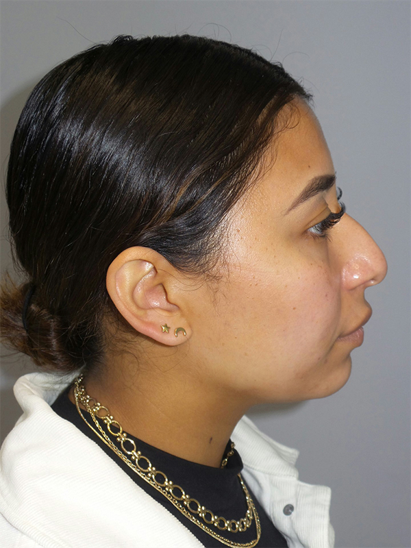 Rhinoplasty Before and After 16 | Sanjay Grover MD FACS