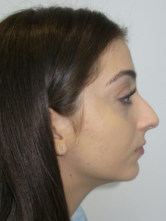 Rhinoplasty Before and After 47 | Sanjay Grover MD FACS
