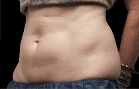 Coolsculpting Before and After | Sanjay Grover MD FACS