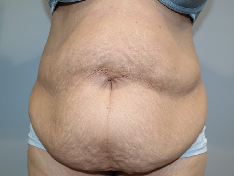 Tummy Tuck Before and After 79 | Sanjay Grover MD FACS