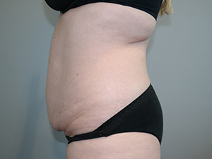 Tummy Tuck Before and After 08 | Sanjay Grover MD FACS