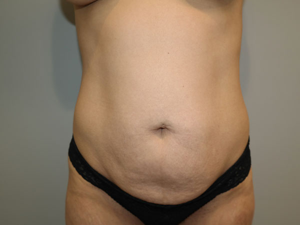 Tummy Tuck Before and After 40 | Sanjay Grover MD FACS