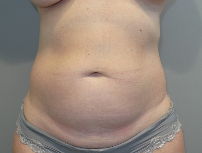 Tummy Tuck Before and After 90 | Sanjay Grover MD FACS