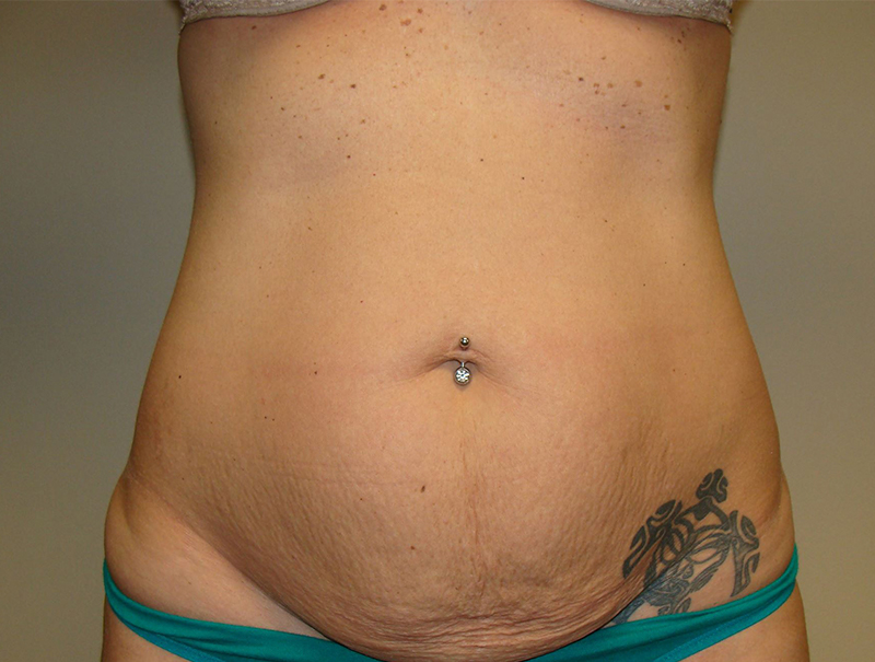 Tummy Tuck Before and After 98 | Sanjay Grover MD FACS