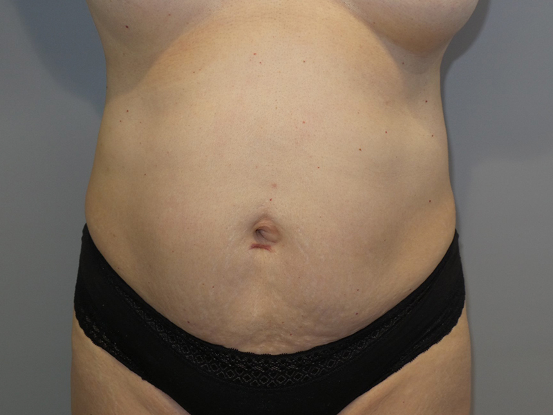 Tummy Tuck Before and After 05 | Sanjay Grover MD FACS