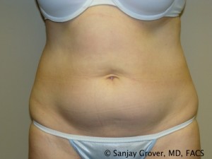 Tummy Tuck Before and After 94 | Sanjay Grover MD FACS