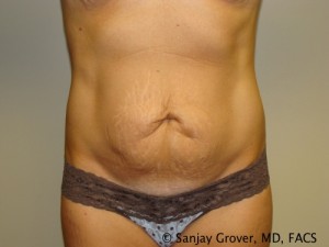 Tummy Tuck Before and After 58 | Sanjay Grover MD FACS