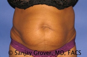 Tummy Tuck Before and After 70 | Sanjay Grover MD FACS
