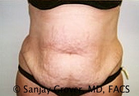 Tummy Tuck Before and After 103 | Sanjay Grover MD FACS
