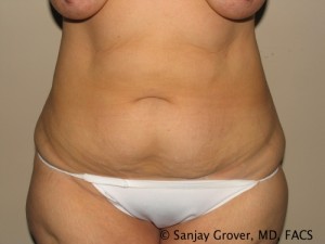 Tummy Tuck Before and After 80 | Sanjay Grover MD FACS