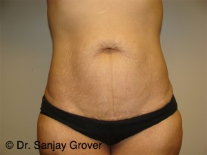 Tummy Tuck Before and After 31 | Sanjay Grover MD FACS