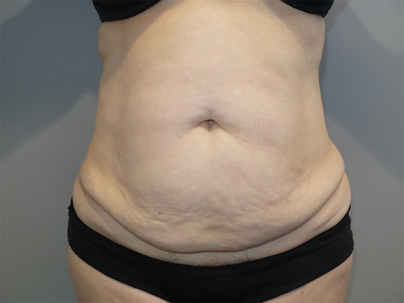 Tummy Tuck Before and After 68 | Sanjay Grover MD FACS