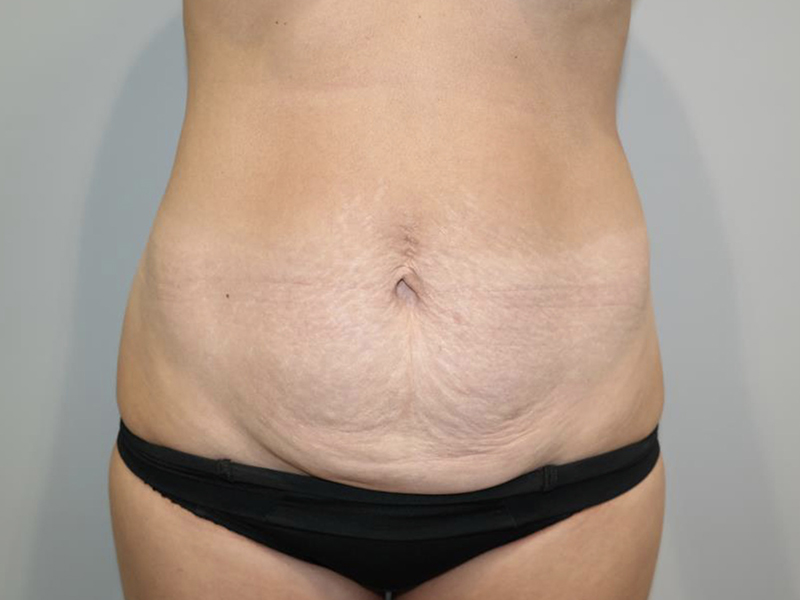 Tummy Tuck Before and After 13 | Sanjay Grover MD FACS