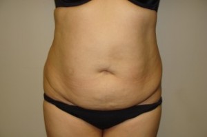 Tummy Tuck Before and After 03 | Sanjay Grover MD FACS