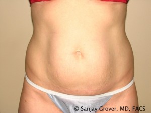Tummy Tuck Before and After 53 | Sanjay Grover MD FACS