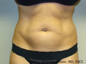 Tummy Tuck Before and After 104 | Sanjay Grover MD FACS