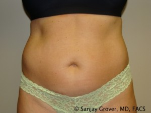 Tummy Tuck Before and After 67 | Sanjay Grover MD FACS