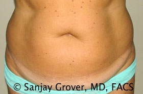 Tummy Tuck Before and After 22 | Sanjay Grover MD FACS