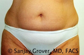 Tummy Tuck Before and After 91 | Sanjay Grover MD FACS