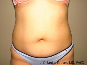 Tummy Tuck Before and After 80 | Sanjay Grover MD FACS