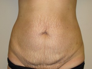 Tummy Tuck Before and After 100 | Sanjay Grover MD FACS