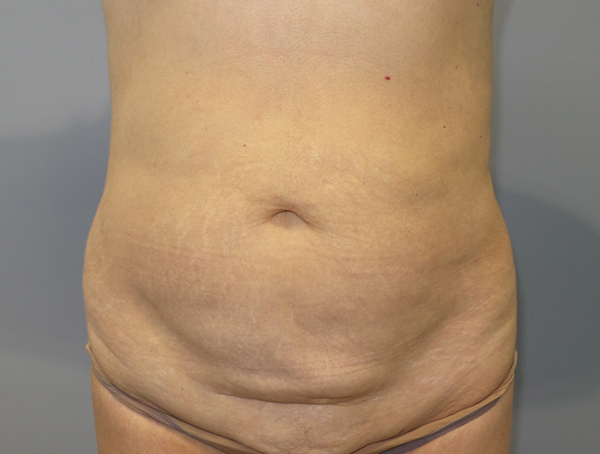 Tummy Tuck Before and After 102 | Sanjay Grover MD FACS