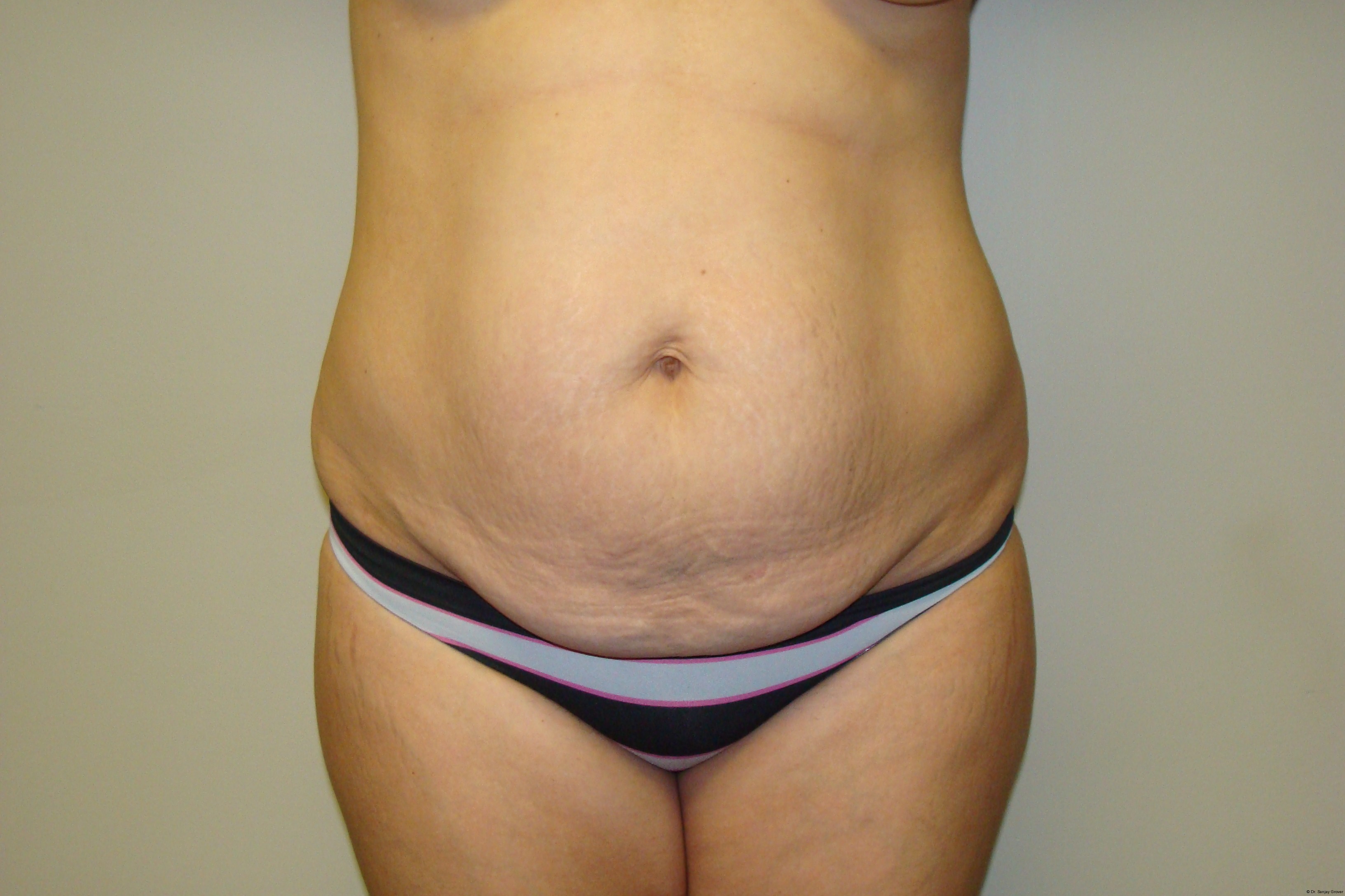 Tummy Tuck Before and After 38 | Sanjay Grover MD FACS