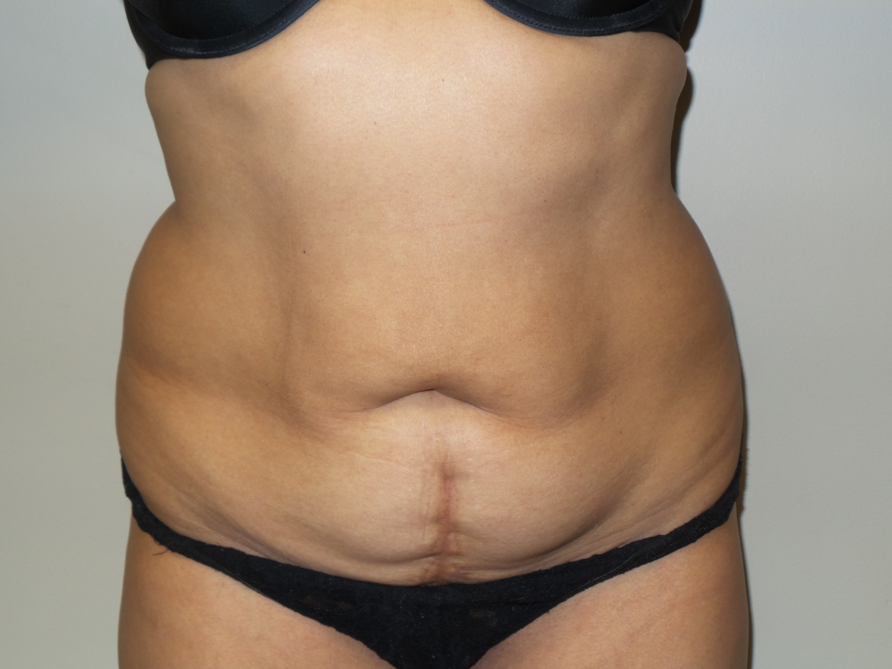Tummy Tuck Before and After 18 | Sanjay Grover MD FACS