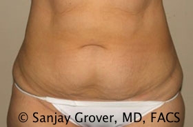 Tummy Tuck Before and After 02 | Sanjay Grover MD FACS