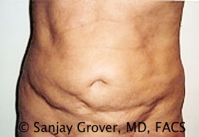 Tummy Tuck Before and After 65 | Sanjay Grover MD FACS