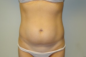 Tummy Tuck Before and After 97 | Sanjay Grover MD FACS