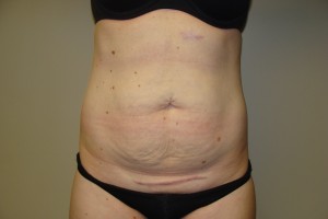 Tummy Tuck Before and After 61 | Sanjay Grover MD FACS
