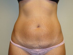 Tummy Tuck Before and After 39 | Sanjay Grover MD FACS