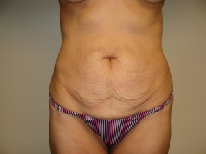 Tummy Tuck Before and After 47 | Sanjay Grover MD FACS