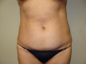 Tummy Tuck Before and After 109 | Sanjay Grover MD FACS
