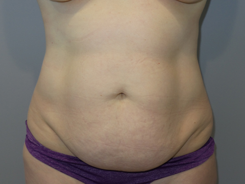 Tummy Tuck Before and After 102 | Sanjay Grover MD FACS