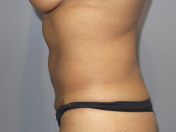 Tummy Tuck Before and After 104 | Sanjay Grover MD FACS