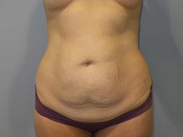 Tummy Tuck Before and After 99 | Sanjay Grover MD FACS